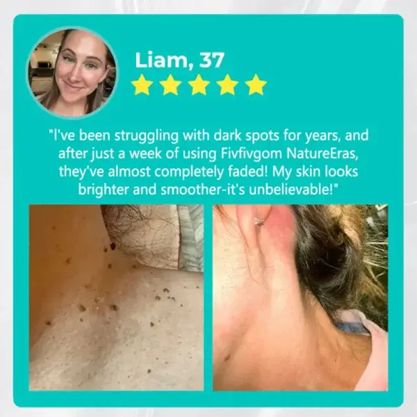 NatureErase Instant Mole & Spot Removal Gel