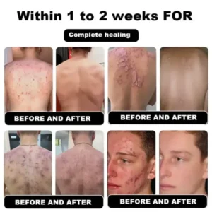 Psoriasis Cure Cream