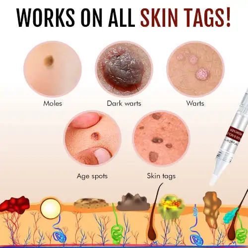 Tags & Moles Remover - Image 5