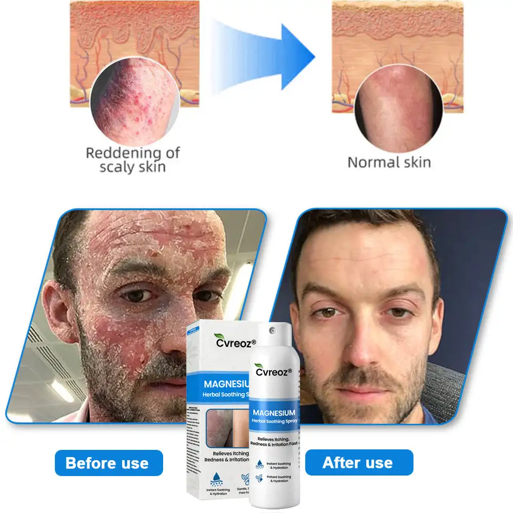 Magnesium Herbal Psoriasis Spray - Image 2