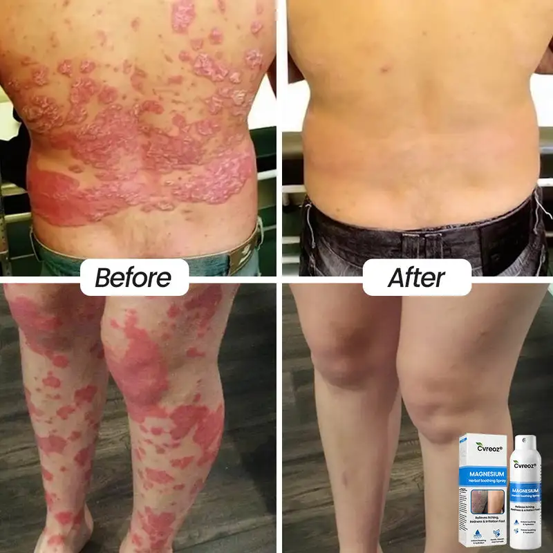 Magnesium Herbal Psoriasis Spray - Image 3