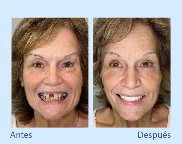 - Prótesis Dental Premium - Image 11