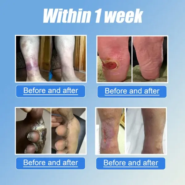VitaGluco Diabetes Treatment Cream - Image 2