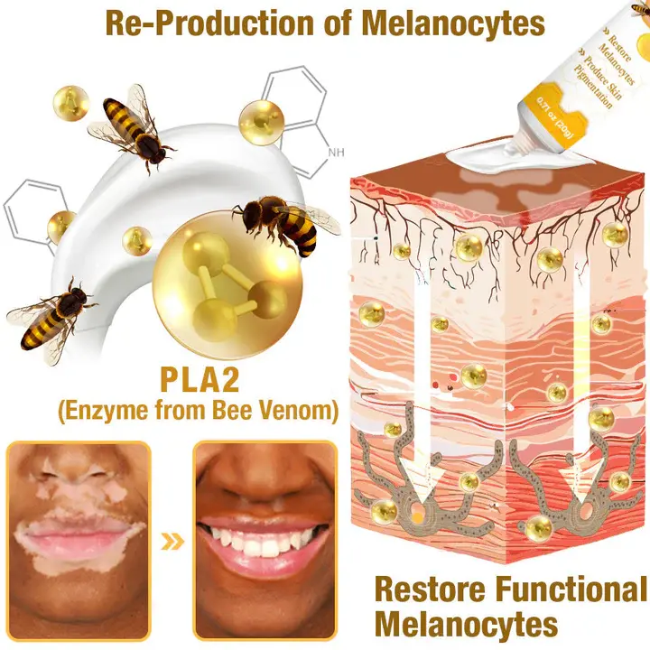 BeeVenom Vitiligo Treatment Cream - Image 2