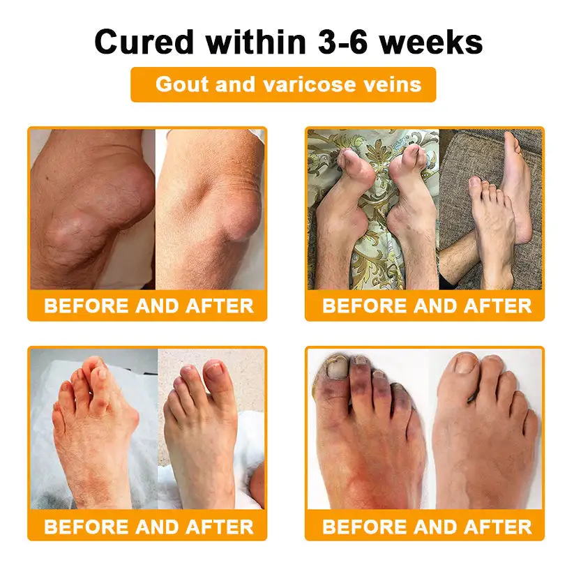 Botulinum Toxin & Bee Poison Pain-Relief Bone Healing Cream - Image 7