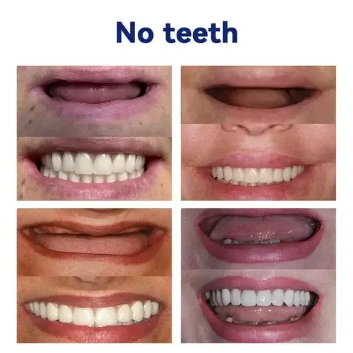 Advanced Customized Full Denture Set - Image 7
