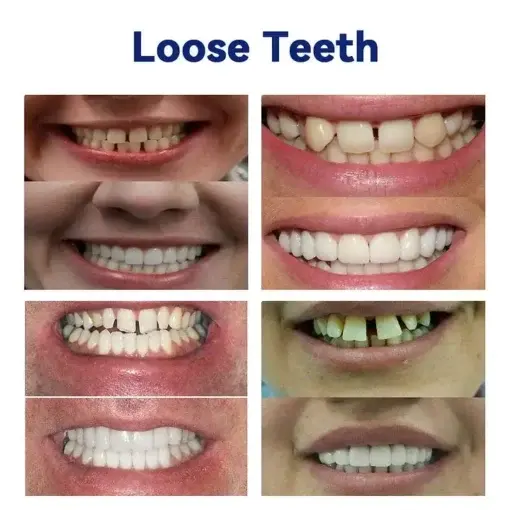 Advanced Customized Full Denture Set - Image 8