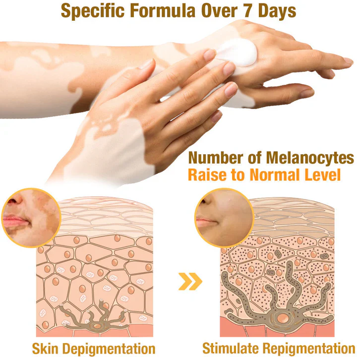 BeeVenom Vitiligo Treatment Cream - Image 2