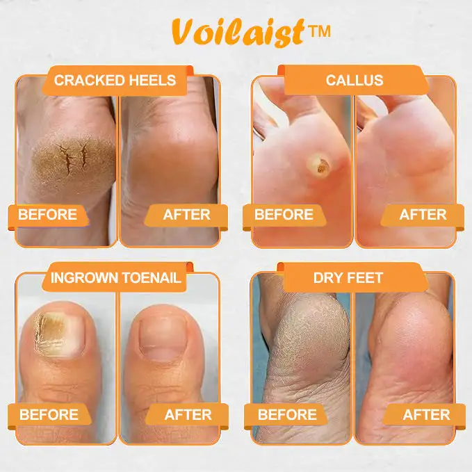 Bee Venom Lymphatic Drainage & Slimming Foot SoakBeads - Image 8