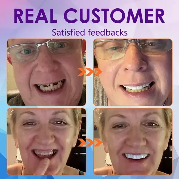 Advanced Customized Full Denture Set - Image 10