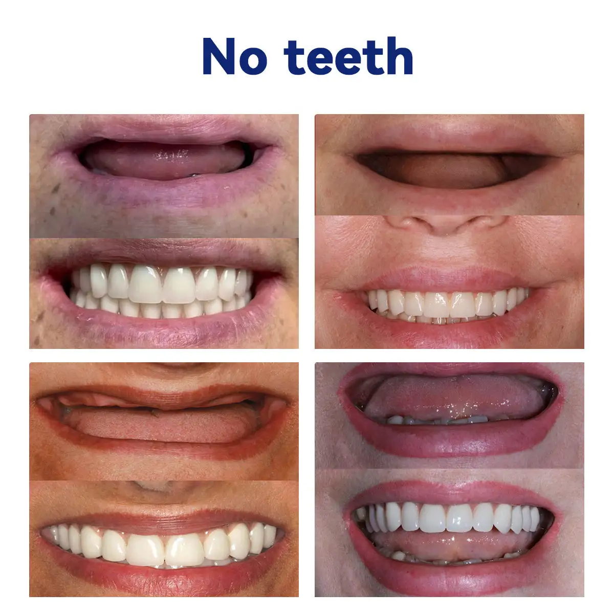 𝑆𝑖𝑙𝑖𝑐𝑜𝑛𝑒 𝐷𝑒𝑛𝑡𝑢𝑟𝑒 𝑅𝑢𝑙𝑒𝑟 𝑆𝑒𝑡 - Image 4