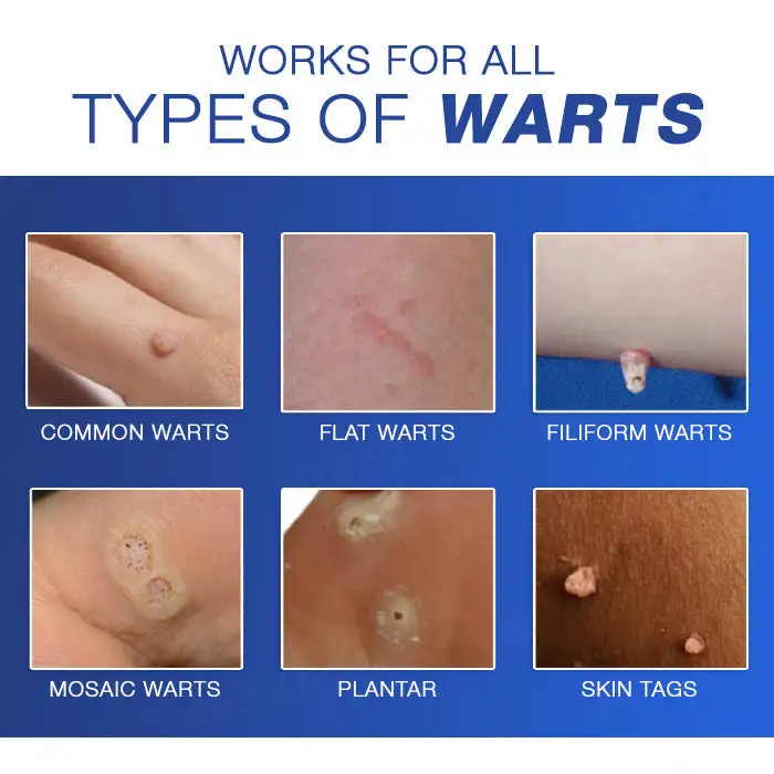 EXCLUSIVE DEAL! 32% OFF - Wart Eraser Pro - Image 6
