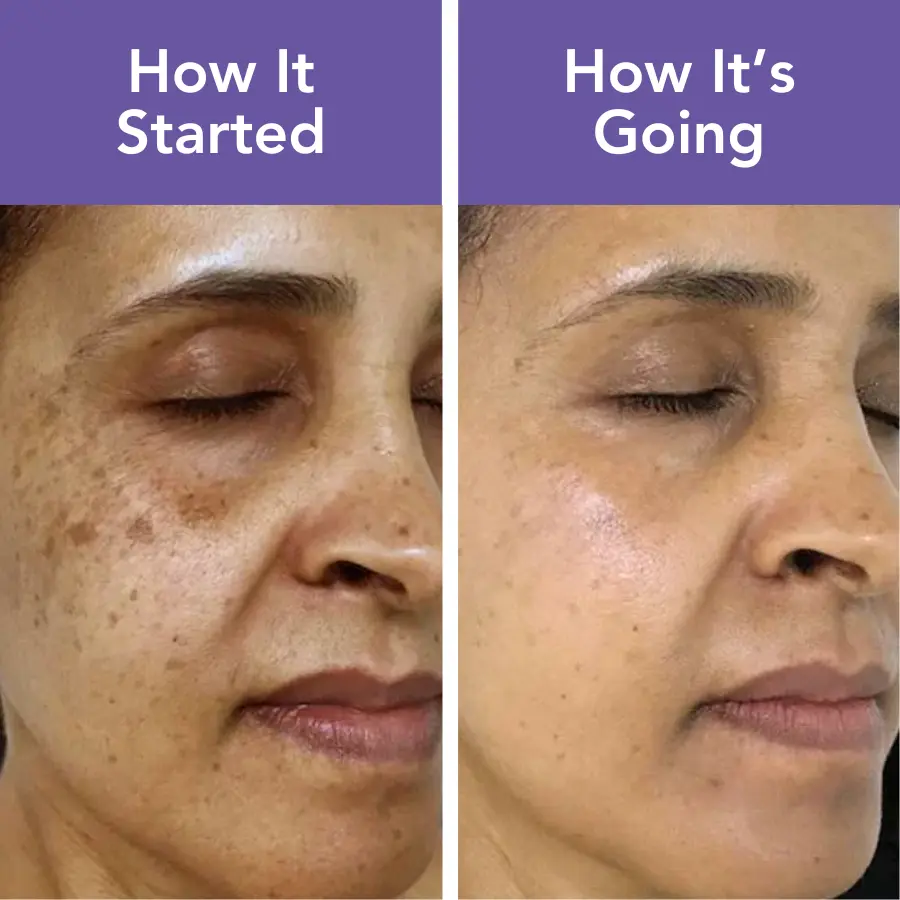 Age Spots Removal Patches - Image 3