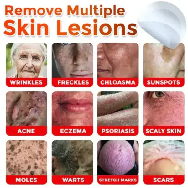 Removal Patch: Gentle Microneedle Patches for Skin Tag & Mole Removal - Image 4