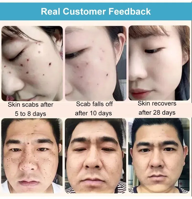 Concentrated potent skin tag removal cream - Image 5