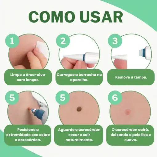 Skin Wart & Skin Tag Removal Kit - Image 4