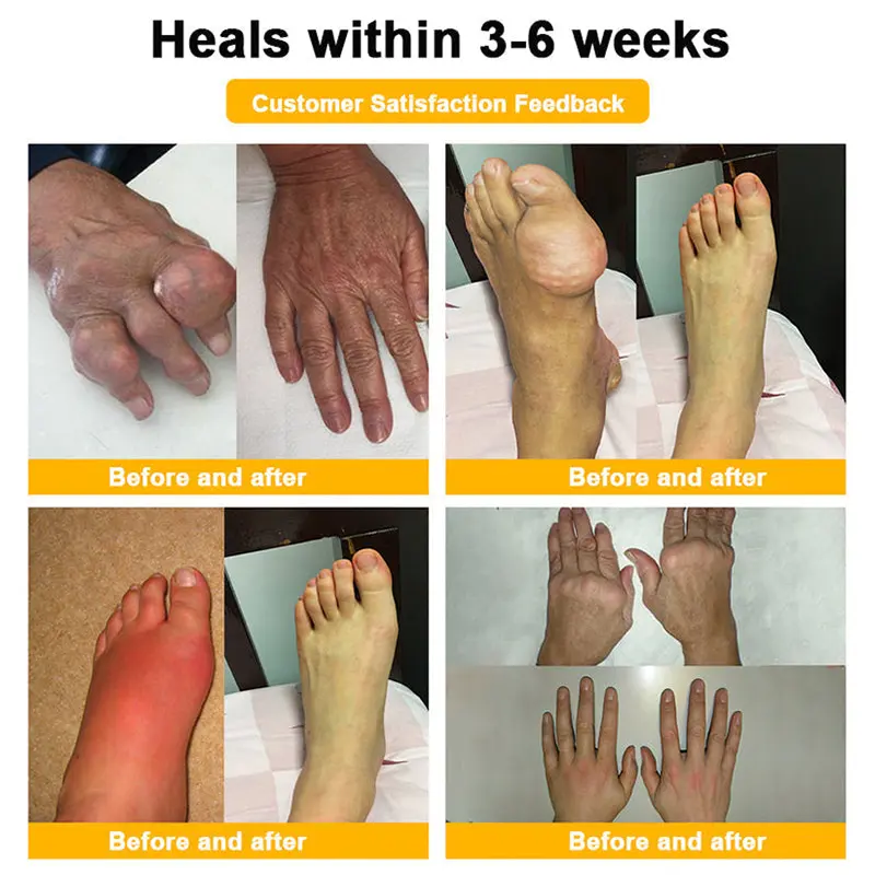 BEE VENOM LITHOSPERMUM Pain-Relief Bone Healing Cream - Image 6