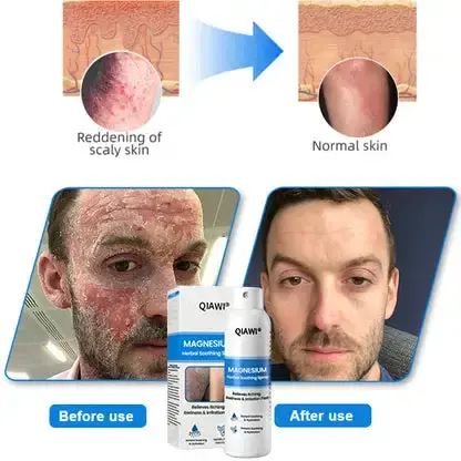 QIAWI Magnesium Herbal Psoriasis Spray - Image 6