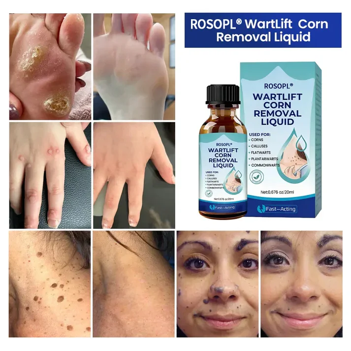 Wart Lift Wart Removal Liquid - Image 3