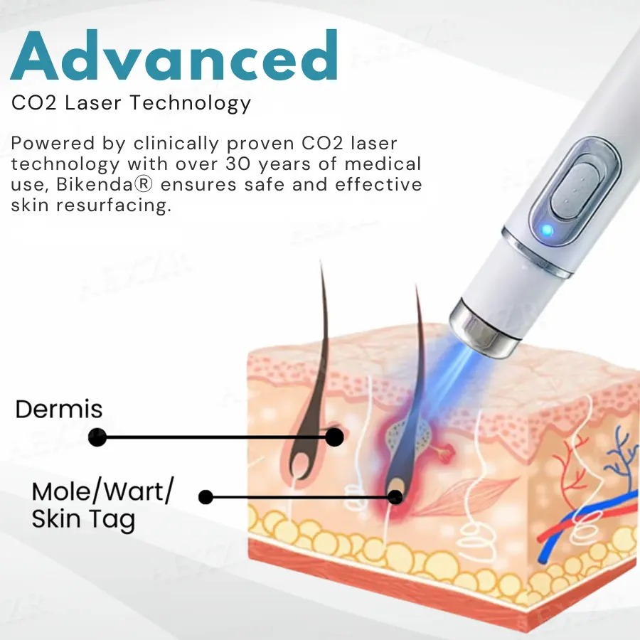 PRO Non-Invasive Mole and Wart Removal Laser Pen - Image 6