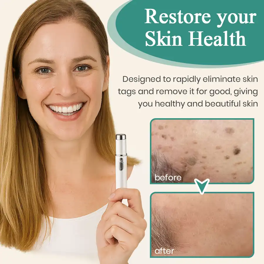 LumeSkin Mole and Wart Instant Removal Laser Pen ACE 4 - Image 2