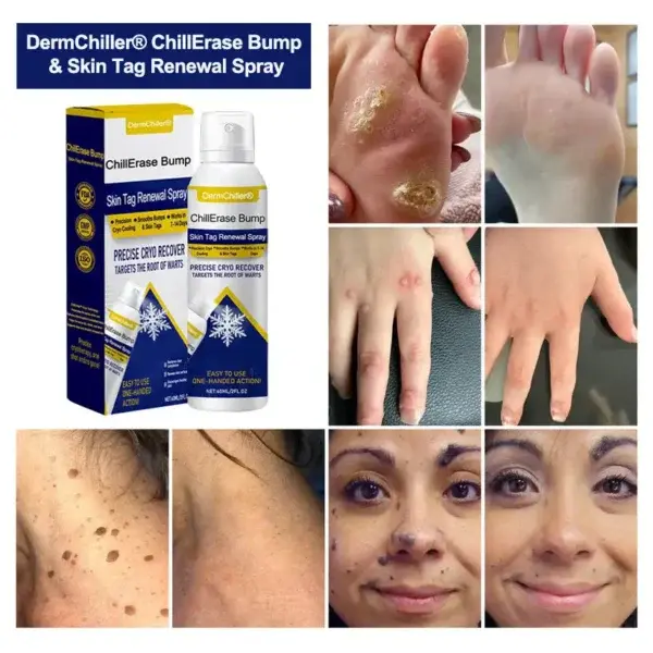 ChillErase Bump & Skin Tag Renewal Spray - Image 2