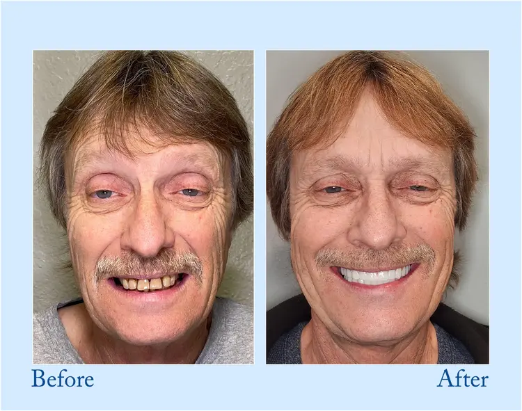 Fluoride-Free Hydroxyapatite Toothpaste - Image 6