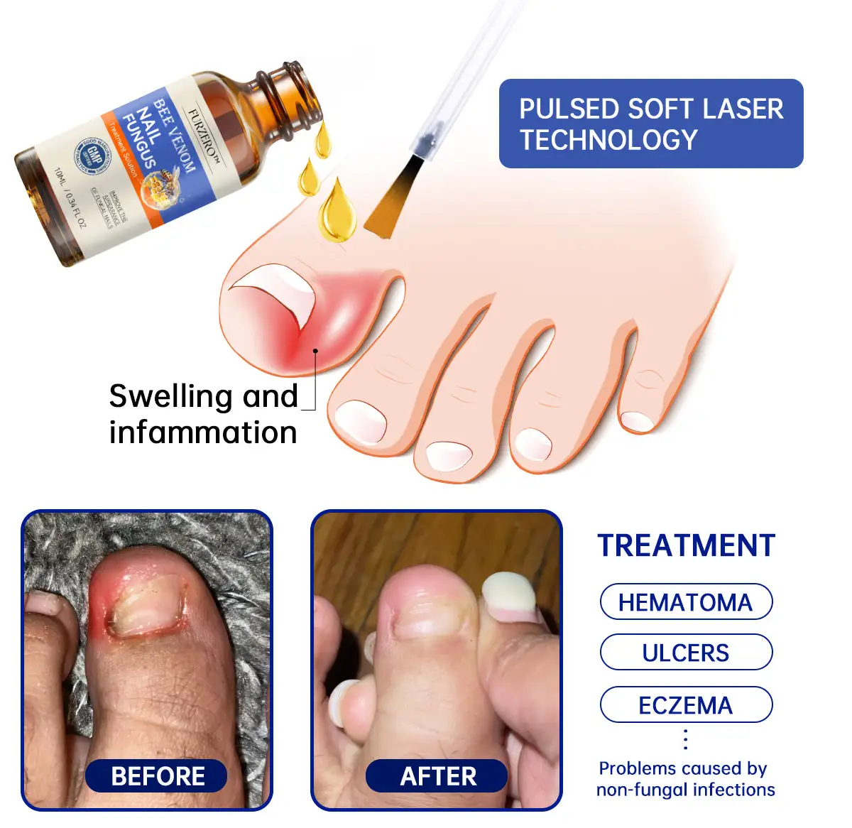 Bee Venom Nail Fungus Treatment Cream - Image 4