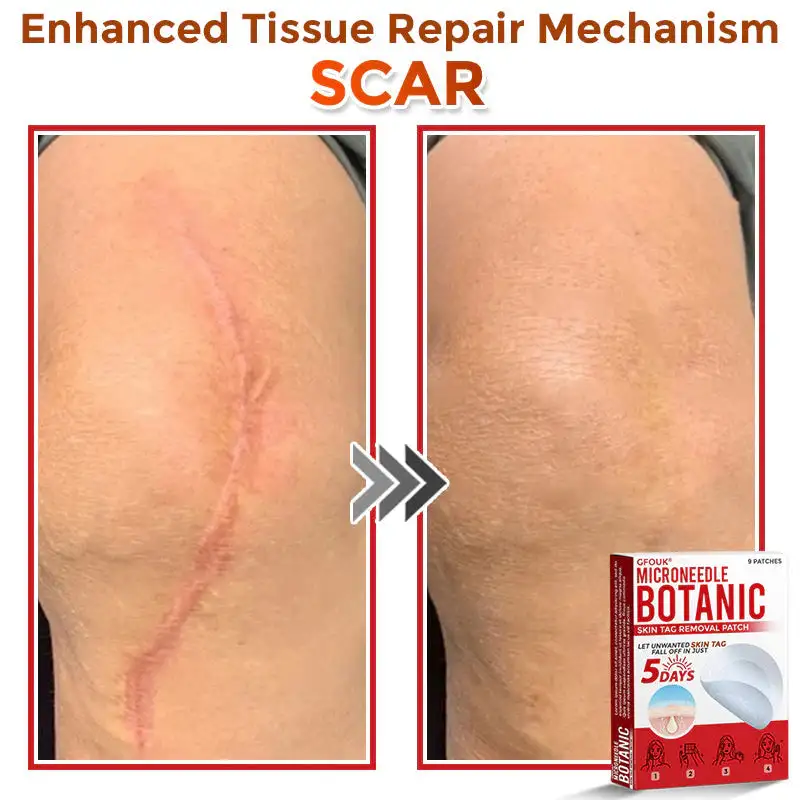 MicroNeedle Botanic Skin Tag Removal Patch - Image 10