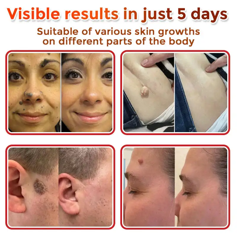 MicroNeedle Botanic Skin Tag Removal Patch - Image 3