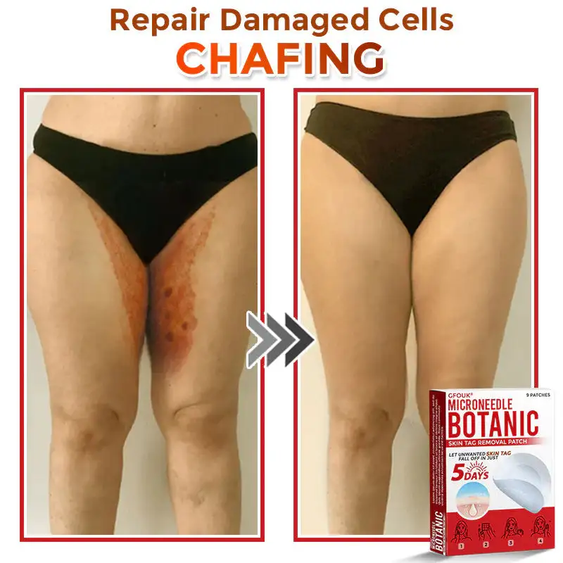 MicroNeedle Botanic Skin Tag Removal Patch - Image 9