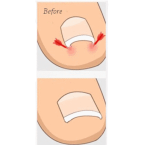 Ingrown Out - Image 6