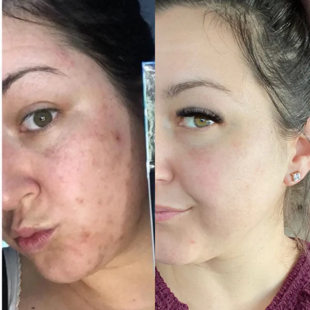 Facial Cream with 7% Arbutin + 4% Tranexamic Acid - Image 5