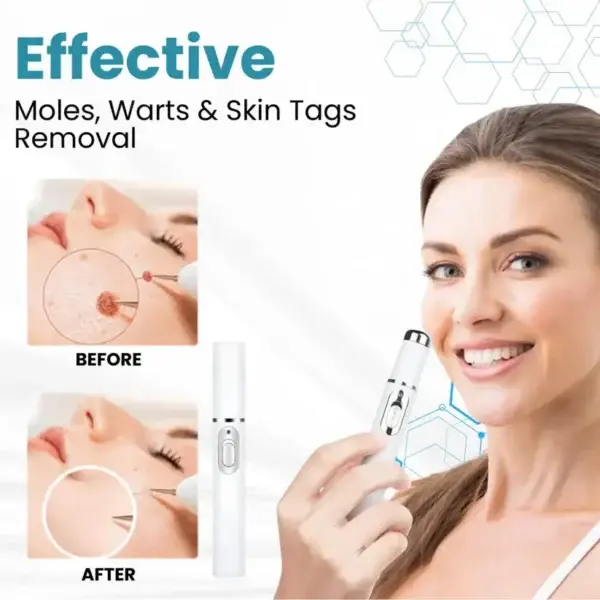 Non-Invasive Mole and Wart Removal Laser Pen - Image 7