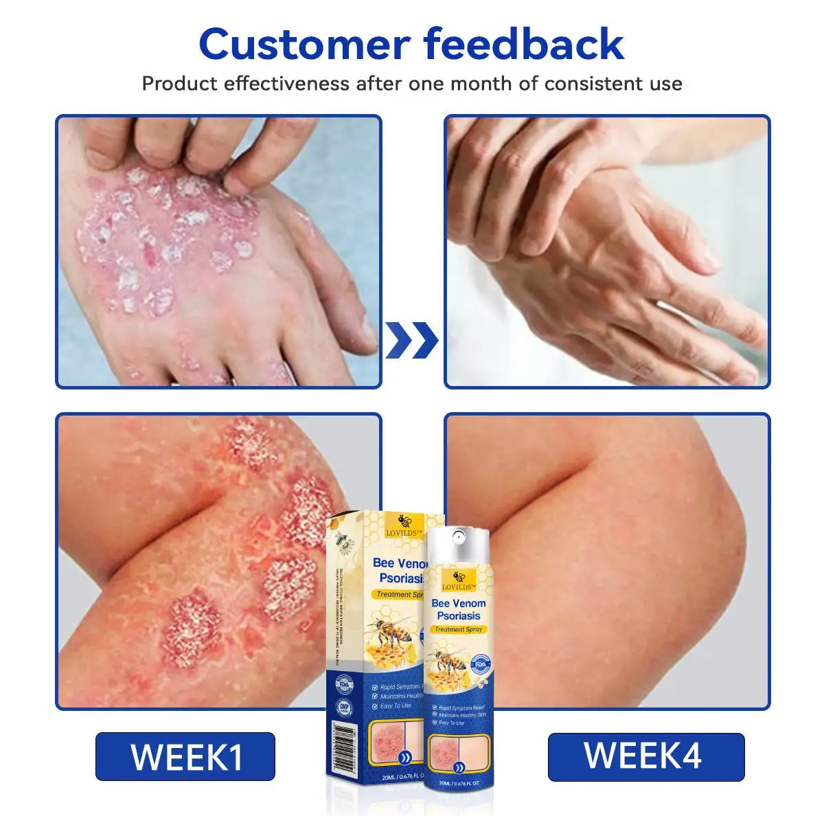 PsoriaHeal Bee Venom Psoriasis Treatment Spray - Image 4