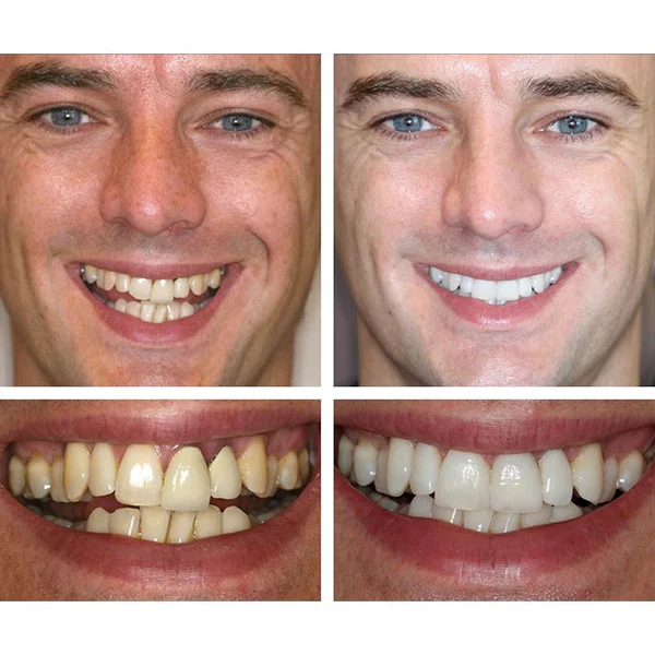 Esencia blanqueadora de dientes - Image 8