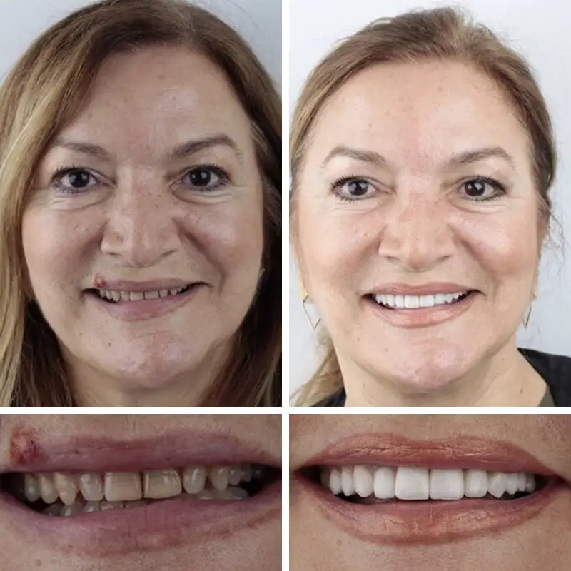 Advanced Customized Full Denture Set - Image 7