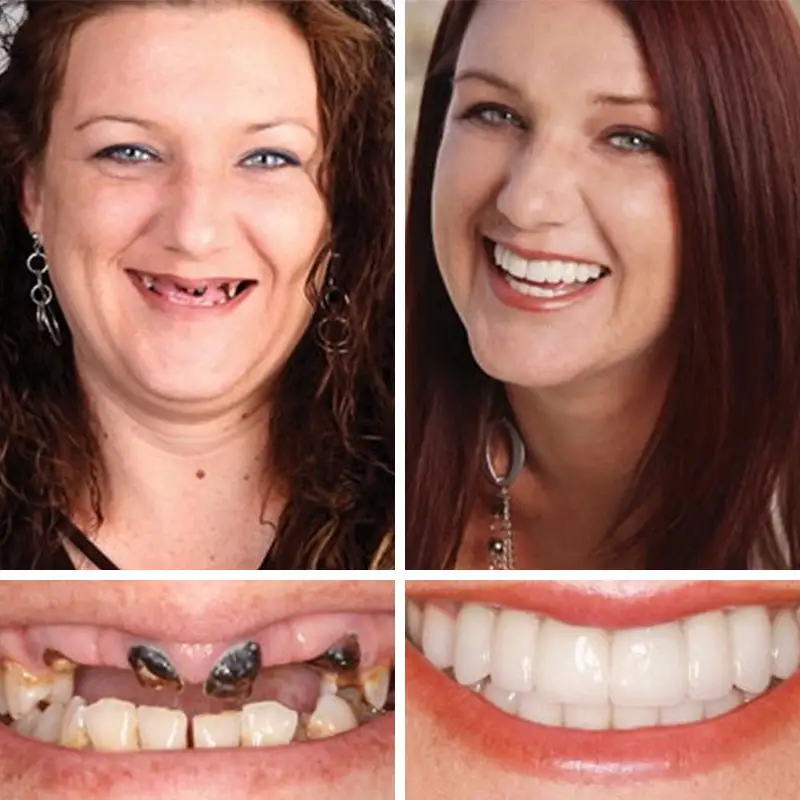 Advanced Customized Full Denture Set - Image 8