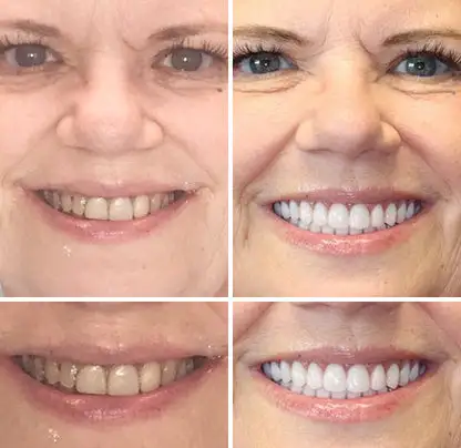 Advanced Customized Full Denture Set - Image 7
