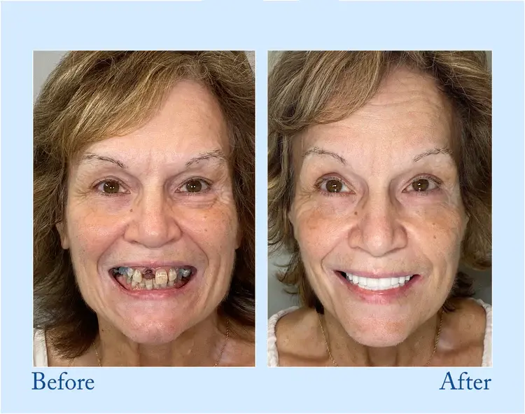 Custom-Fit Functional Dentures - Image 8