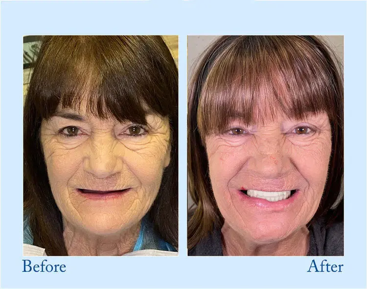 Custom-Fit Functional Dentures - Image 9