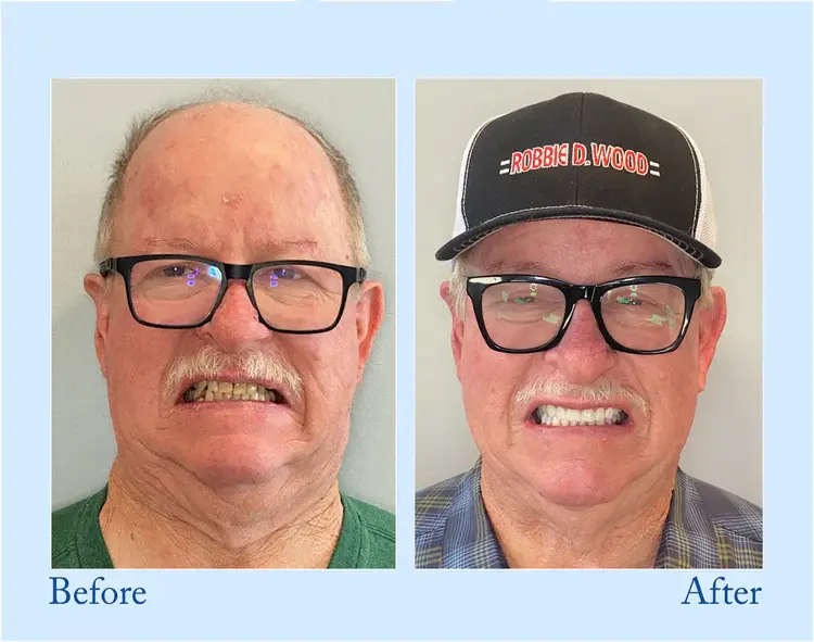 Custom-Fit Functional Dentures - Perfectly Fitted in Minutes at Home - Image 10