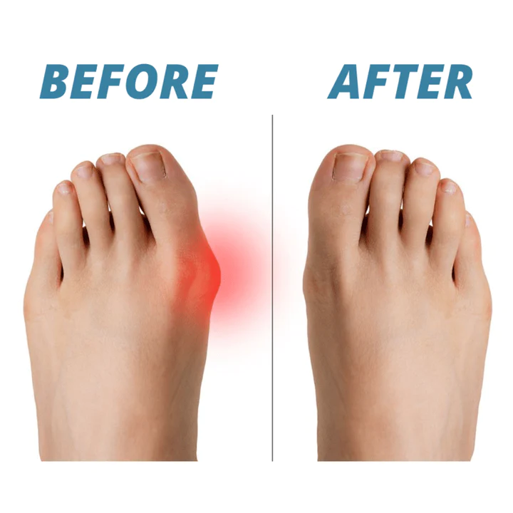 Premium Bunion Corrector Sock - Image 2