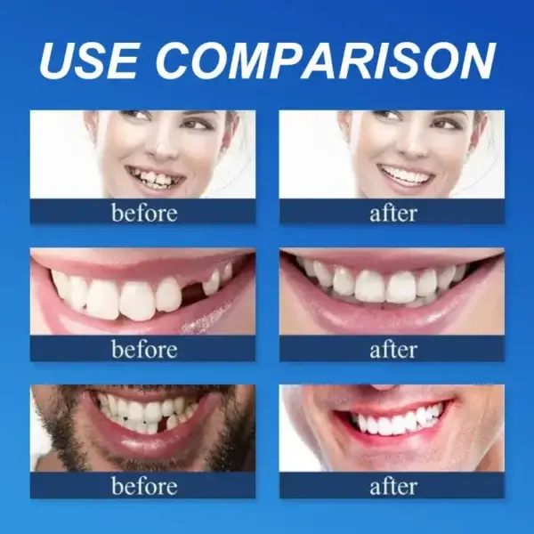Advanced Customized Full Denture Set - Image 11