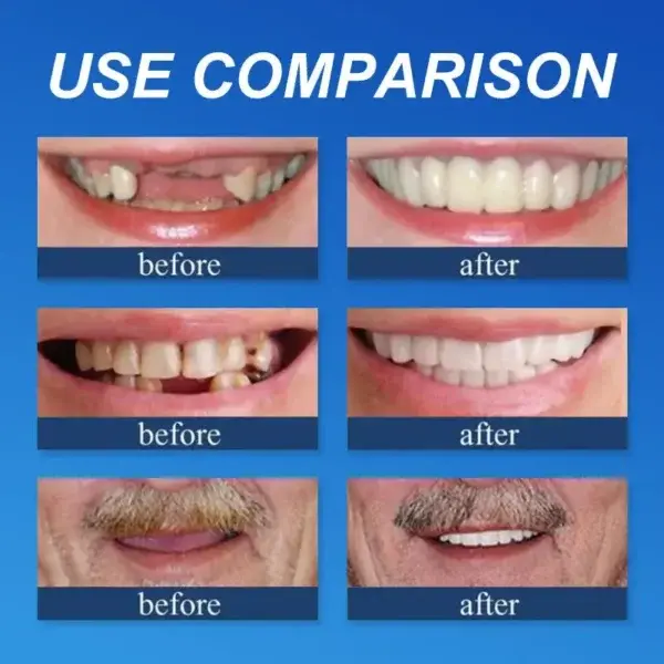 Advanced Customized Full Denture Set - Image 12