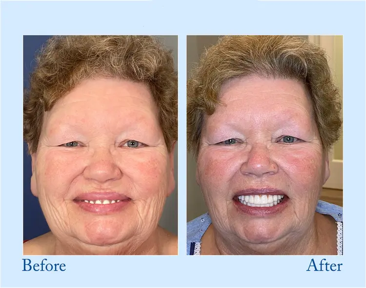 Custom-Fit Functional Dentures – Full Set - Image 10