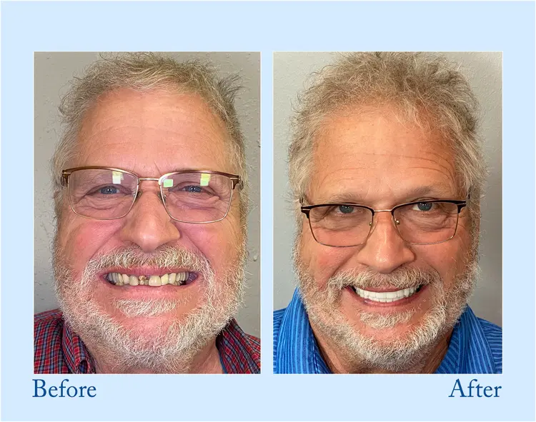 Custom-Fit Functional Dentures – Full Set - Image 6