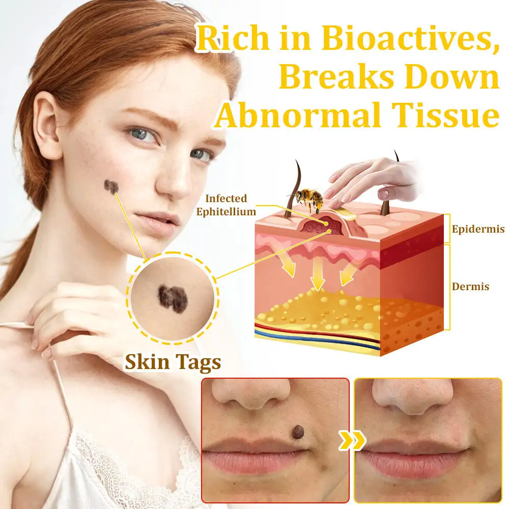 Bee Venom Treatment Cream🐝: Treat Eczema, Psoriasis, Acne, Rosacea, Fungal Infections, Warts - Image 9