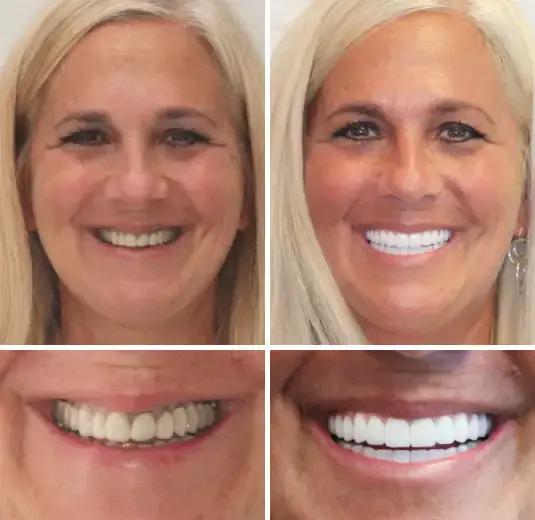 Advanced Customized Full Denture Set - Image 6