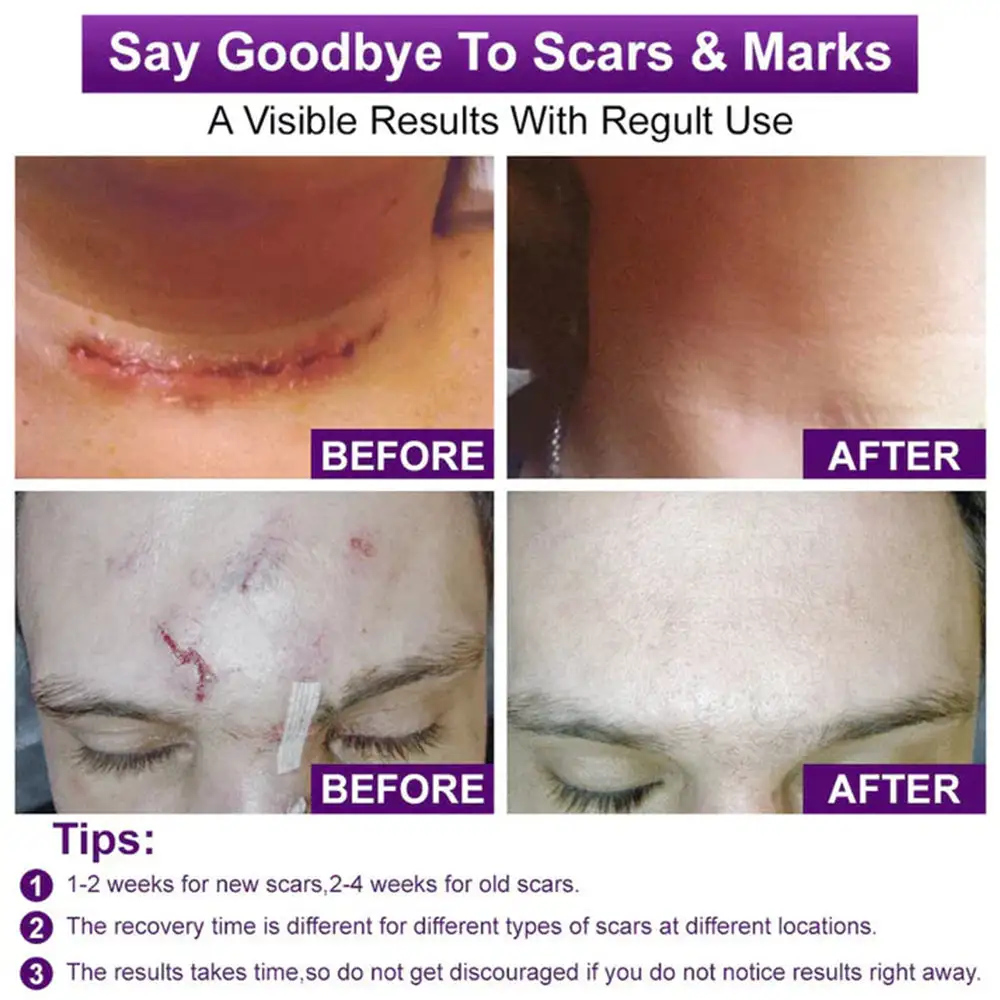 Stem Cell Scar Gel - Image 2